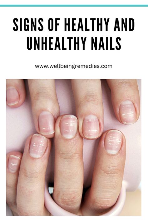 Signs of Healthy and Unhealthy Nails Nail Problems Health Signs, Finger Nails Health, Nail Health Signs, Fingernail Health, Nail Ridges, Nail Signs, Bad Nails, Nail Problems, Diy Beauty Treatments