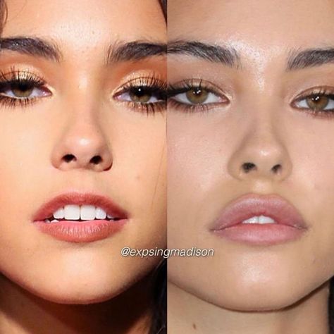 Madison Beer Plastic Surgery, Madison Beer Makeup, Face Plastic Surgery, Lip Flip, Lips Inspiration, Botox Lips, Facial Surgery, Permanent Cosmetics, Eyebrow Grooming