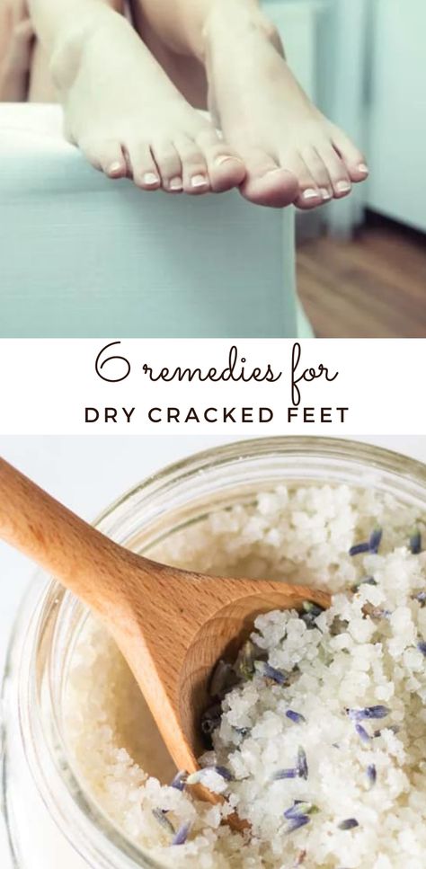 The best way to remove dry, cracked skin on feet naturally with these simple tips and tricks. Dry Cracked Feet Remedy Diy, Dry Cracked Feet Remedy, Cracked Feet Remedies, Natural Face Wash, Soda Recipe, Homemade Bath, Scaly Skin, Homemade Soap Recipes, Natural Skin Care Routine