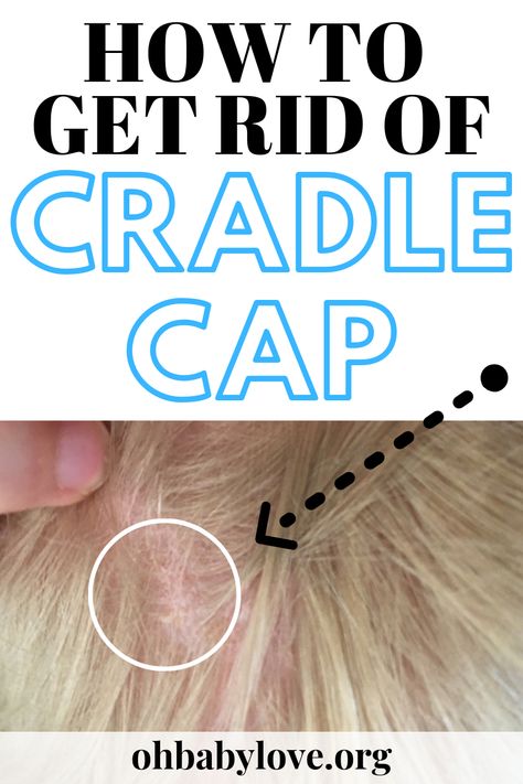 How to Get Rid of Baby and Toddler's white or yellow scales or dry patches on their scalp called cradle cap. Stop doing the same thing over and over that only gives a temporary fix. Get rid of it for GOOD. #baby #toddler #newborn #cradlecap #scalp #babyhacks #babystuff Toddler Dry Scalp, Toddler Cradle Cap, Cradle Cap Remedies, Toddler Hacks, Infant Care, Newborn Needs, Cradle Cap, Flaky Scalp, Toddler Lunches