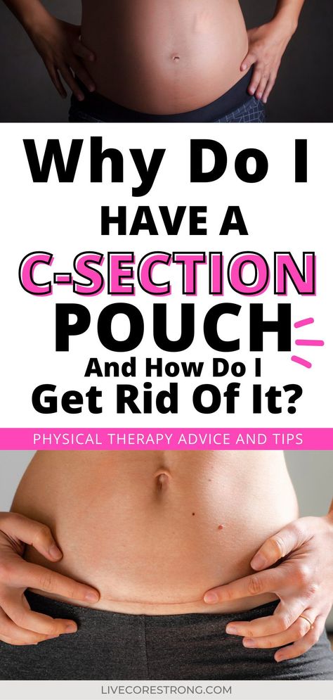 C Section Pouch, C Section Belly, Post C Section, C Section Workout, Belly Pouch, Post Baby Belly, Postpartum Tummy, Postpartum Tips, Losing Mom