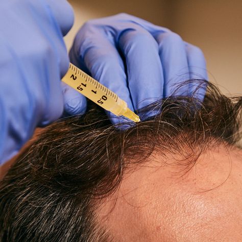 Stop hair loss with Platelet-Rich Plasma. Thousands of men are protecting their most valuable masculine assets through the new science of hair preservation using PRP.  https://hair.barbersurgeonsguild.com/platelet-rich-plasma/⠀ Medical Brand, Prp Hair, Platelet Rich Plasma, Beauty Products Photography, Skin Clinic, Medical Spa, Med Spa, Dental Clinic, Instagram Aesthetic