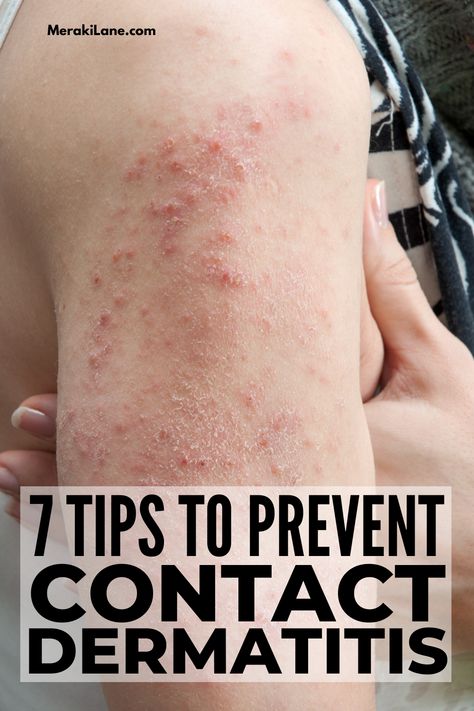 12 Prevention Tips and Natural Remedies for Contact Dermatitis | What is contact dermititis, what causes it, what are the symptoms, and what can be done to treat and prevent this inflammatory skin condition and the red, itchy, blistery rash it creates? We're answering all of these questions - and more! Click for the best natural remedies for contact dermatitis that are safe for babies, kids, and adults, plus preventative tips and home remedies to help you avoid future flare ups! Skin Rash Remedies, Heat Rash Remedy, Skin Rashes Pictures, Home Remedies For Rashes, Rash On Hands, Rash Remedies, Itchy Skin Rash, Body Rash, Itchy Skin Remedy