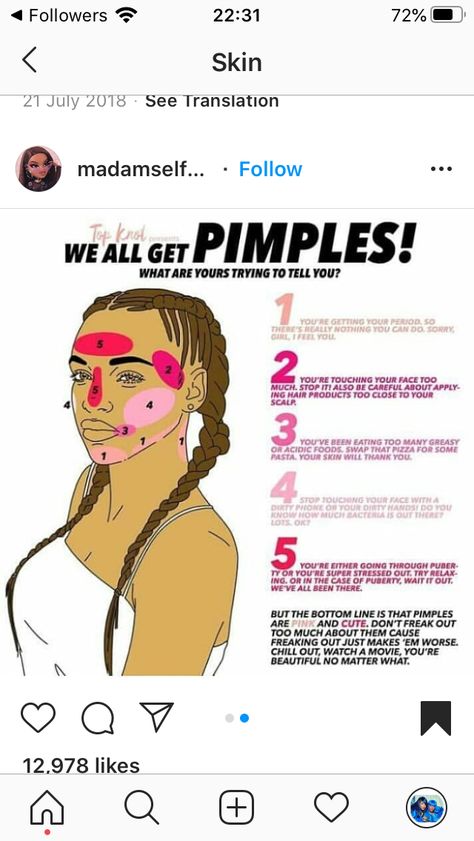 What Pimples In Different Places Means, How To Treat Pustule Acne, How To Get Rod Of Pimples Fast At Home, Pimple Area Meaning, What To Do After Popping Pimples, Pimple Chart, How To Hide Pimples, Cheek Pimples, Bumps On Face