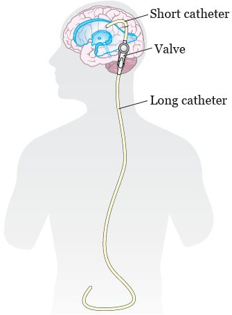 Vp Shunt, Brain Surgery Recovery, Brain Images, Radiology Technologist, Spina Bifida, Brain Surgery, Patient Education, Surgery Recovery, Medical Field