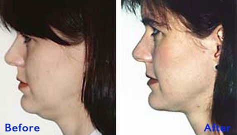 Facial Exercises To Stymie And Overcome A Double Chin Rid Of Double Chin, Face Lift Exercises, Double Chin Removal, Double Chin Exercises, Chin Exercises, Face Firming, Lifting Workouts, Natural Beauty Diy, Slimmer Face