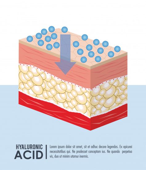 Hyaluronic acid filler injection infogra... | Premium Vector #Freepik #vector Infographic Flyer, Filler Injection, Skincare Science, Hyaluronic Acid Fillers, Hair Science, Vector Infographic, Social Post, Flyer Poster, Hyaluronic Acid