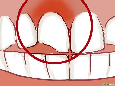 How To Fix A Chipped Tooth, Chipped Tooth Repair Diy, Chipped Tooth Repair, Teeth Repair, Smile Tips, Tooth Pain Relief, Dental Animation, Rotten Teeth, Broken Teeth