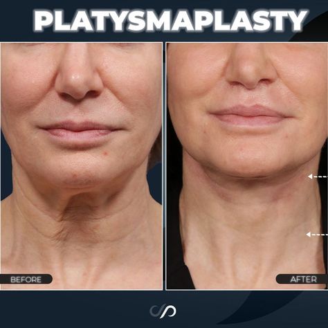 Neck Lift Before And After, Lower Face Lift Before And After, Neck Rejuvenation, Mid Face Lift, Lower Face Lift, Thread Lift Face, Neck Lift Surgery, Saggy Neck, Face Lift Surgery