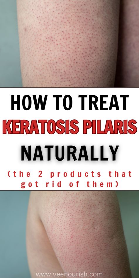 How To Treat Keratosis Pilaris Naturally | KP Natural Remedies How To Get Rid Of Bumps On Private Area, Bumpy Arms Remedy, Lotion For Bumpy Skin, Bumps On Legs Get Rid Of, Bumpy Skin Remedies, Red Bumps On Legs How To Get Rid Of, Kp Skin Remedies, How To Get Rid Of Bumps On Arms, Small Bumps On Arms