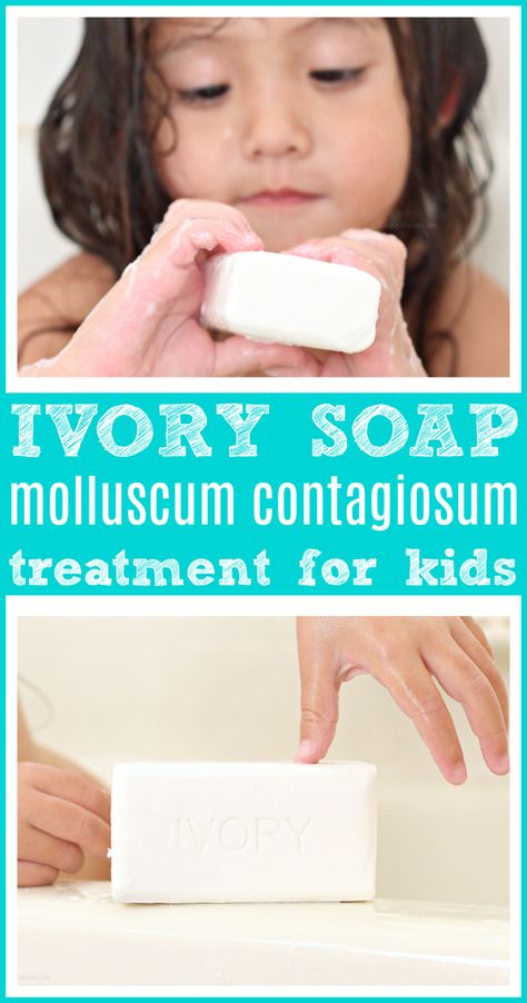 Using Ivory Soap to Treat Molluscum Contagiosum in Kids | My doctor recommended using Ivory for my child's diagnosis #ivorysoap #kids #health #kidshealth Molluscum Contagiosum, Ivory Soap, Herbal Soap, Gastrointestinal System, Childhood Obesity, Doctor Visit, How To Make Homemade, Kids Health, Lungs