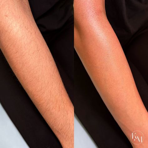 full arm wax service 🤎 . i performed this service using soft wax & muslin strips. i was able to remove every single hair without having to go over the same spot multiple times. soft wax is great for removing hair on larger body surface areas! 🧼 . she usually shaves, which is why her hair looked coarse. if she stays consistent with waxing every 4-6 weeks, her hair will start growing back slower & thinner over time. i loved being able to clean up her arms for her! the before & after was so ... Waxing Before And After, Arm Waxing, Full Body Wax, Why Her, Body Waxing, Paul Mitchell, Esthetician, Hair Removal, Clean Up