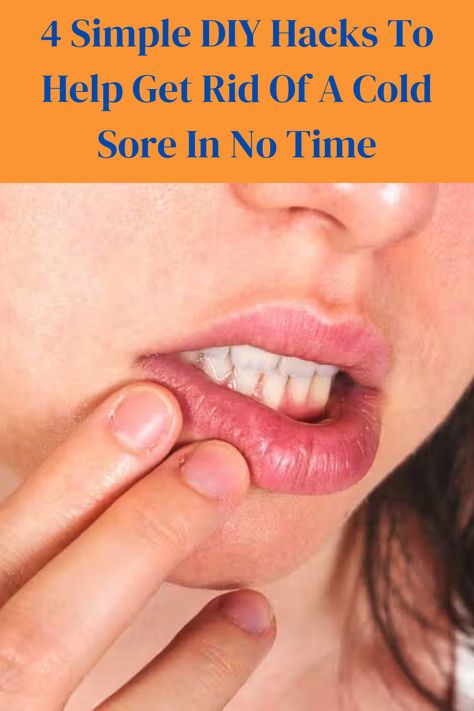 Cold sores are not only annoying, they can be very painful. And … they are highly contagious. But what exactly is a cold sore? It’s a blister located outside of the mouth, mostly along the lip edge. Diy Cold Sore Remedy Fast, How To Get Rid Of Cold Sores Overnight, Cold Sore On Lip, Lip Blister, Cold Sore Lip, Blister On Lip, Landscaping Hacks, Cold Sore Relief, Home Remedies For Allergies