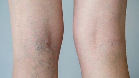 Find out how to get rid of spider veins and varicose veins—and how to prevent visible veins from coming back. Home Remedies For Spiders, Thread Veins, Visible Veins, Diy Remedies, Muscle Aches, Running Tips, Dry Brushing, Natural Living, Massage Therapy