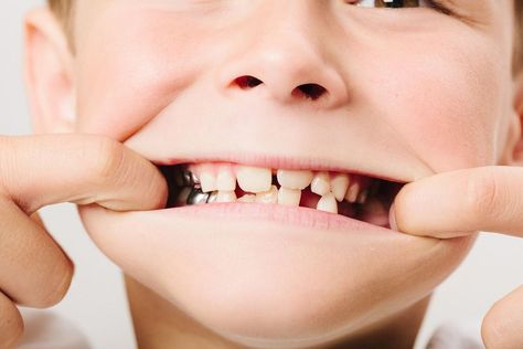 The term silver tooth kid refers to kids that get silver caps placed on their decaying baby teeth. However, it can also allude to a meme that describes a 'bad' kid. #parenting #parents Baby Teeth Jewelry, Silver Tooth, Bad Kid, Toddler Gear, Kids Teeth, Amazon Prime Day Deals, Teeth Jewelry, Real Moms, Bad Kids