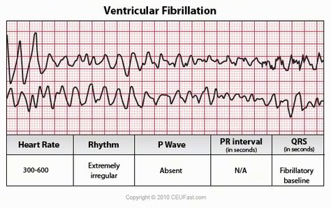 Ventricular Fibrillation Ventricular Fibrillation (VF) Rate: rapid and disorganized Rhythm: irregular and chaotic P Wave: absent but can be recognizable PRI: not measurable QRS: fibrillatory waves; wide irregular oscillations of the baseline. Ekg Rhythms, Cardiac Anatomy, Paramedic Student, Ekg Interpretation, Ecg Interpretation, Paramedic School, Nursing Mnemonics, Nurses Station, Cardiac Nursing