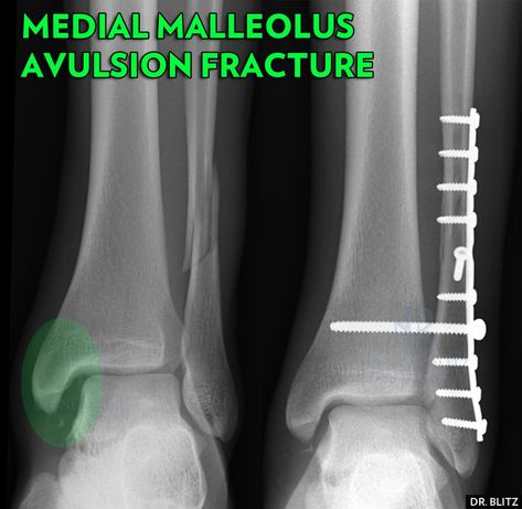 Ankle Cast, Broken Ankle Recovery, Avulsion Fracture, Ankle Recovery, Ankle Fracture, Twisted Ankle, Not Feeling Well, Broken Ankle, Bone Diseases