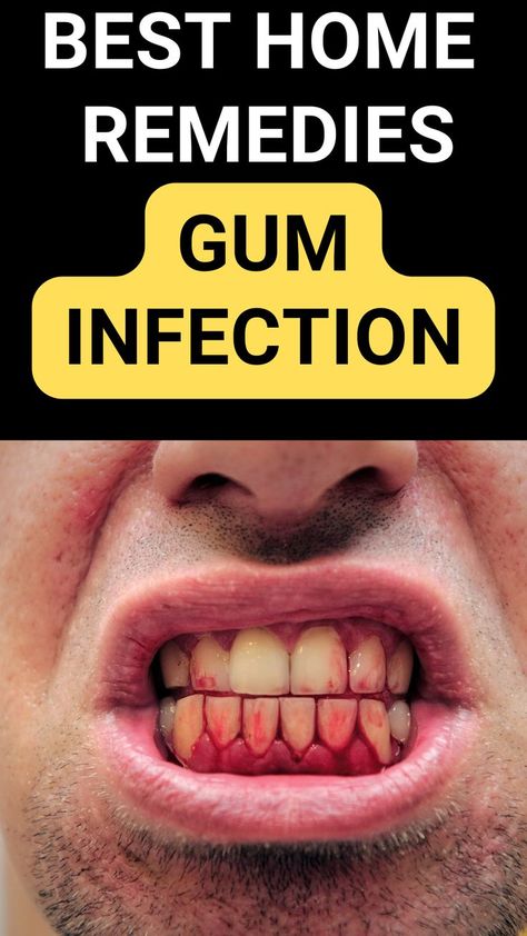 10 Home Remedies to Treat Gum Infection#Gingivitis #homeremediesforguminfection #guminfectionhomeremedies #howtotreatguminfectionhomeremedies #gingitivisremedies Home Health Remedies, Body Healing, Water Can, Dentures, Home Health, Health Remedies, Home Remedies, Health Tips, Disease