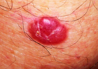 Basal cell carcinoma copy Basal Cell On Face, Squamous Carcinoma, Basel Cell Carcinoma Pictures, Basil Cell Carcinoma, Basal Cell, Squamous Cell, Skin Bumps, Save Your Life, Skin Cells