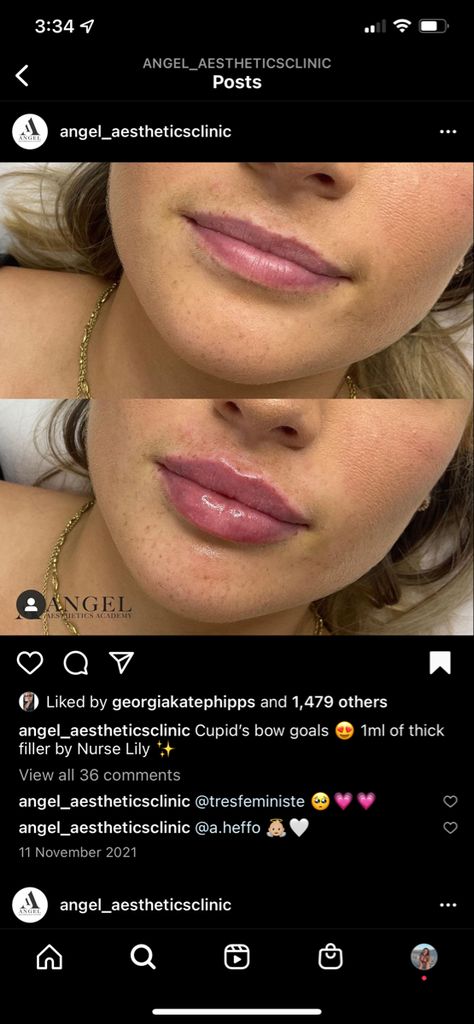 Hailey Beiber Lips Before And After, Lip Filler Before And After Round Lips, Natural Looking Filled Lips, Small Lip Injections Before And After, Light Lip Injections, Lip Fuller Shapes, M Shape Lips, Lip Fillers Cupids Bow, Lip Filler Transformation