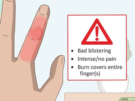 How To Treat A Burn Skin, Burned Skin Remedies, Burn Blister, How To Treat Blisters, Curling Iron Burn, Water Blister, Blister Remedies, 2nd Degree Burns, Burned Finger