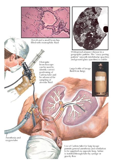 Body Knowledge, Hypersensitivity Reactions, Medical Dictionary, General Anaesthesia, Crazy Paving, Pulmonology, Biomedical Science, Lip Care Routine, Medical School Essentials