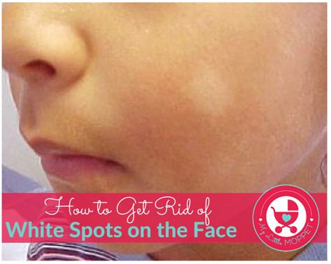 White patches on your child's face can be scary, but it's probably Pityriasis Alba. Read on to know more about how to get rid of white spots on the face. Pityriasis Alba, White Spots On Skin, White Skin Patches, White Skin Spots, Vitamin Foods, Spots On Skin, Blind Pimple, Forehead Acne, Brown Spots Removal