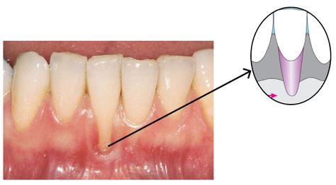 Gum recession is a common condition. In its localized form, it often appears on a single tooth. It is the result of multiple factors, but trauma and plaque are the most well-known triggers. Grow Back Receding Gums, Tooth Filling, Blackhead Remedies, Gum Recession, Loose Tooth, Human Teeth, Receding Gums, Diy Remedies, Hormone Health