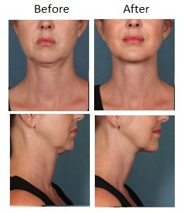 Kybella - Before and After.  Wow! Radiesse Before After, Coconut Oil Hair Growth, Botox Before And After, Body Ideas, Aesthetic Center, Before And After Pics, Facial Fillers, Coconut Oil Hair Mask, Botox Fillers