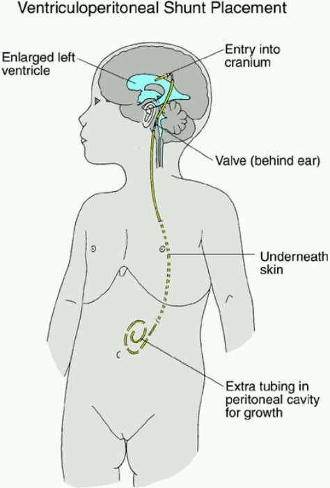 Shunt. I have one of these:) Vp Shunt Surgery, Vp Shunt, Camp Nurse, Charting For Nurses, Nicu Nursing, Emt Study, Nursing Flashcards, Spina Bifida Awareness, Brain Tumors