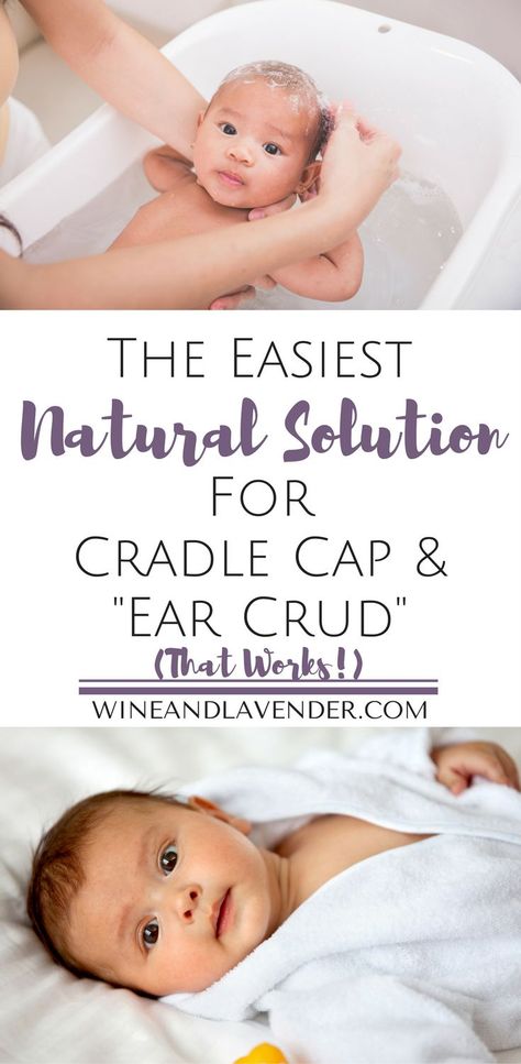 Natural Remedies For Cradle Cap, Cradle Cap Remedies For Adults, How To Get Rid Of Cradle Cap, Cradle Cap Remedies, Baby Cradle Cap, Make It Or Break It, How To Breastfeed, Diaper Bag Essentials, Cradle Cap