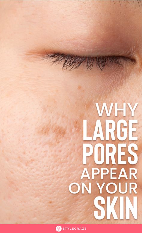 Reducing Pore Size On Face, Large Pores On Face Products, Facial Pores Remedies, How To Reduce Large Pores On Face, Get Rid Of Big Pores On Face, Skincare Routine For Large Pores, Decrease Pores On Face, Small Pores How To Get, Cleaning Pores On Face