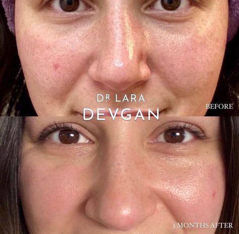 Dr. Lara Devgan Scientific Beauty on Instagram: "Real client results with my RETINOL+BAKUCHIOL SERUM Here we can see beautiful improvement in pore size, hyperpigmentation, and overall skin tone. My Retinol+Bakuchiol Serum is my #1 anti-aging essential for preventing, correcting, and achieving a clear and radiant complexion. RETINOL is a hero anti-aging ingredient that improves smoothness of the skin. BAKUCHIOL is a plant-based anti-oxidant and anti-inflammatory that is structurally similar Bakuchiol Serum, Anti Aging Regimen, Retinoic Acid, Medical Questions, Daily Sunscreen, Hyaluronic Serum, Antioxidant Serum, Anti Aging Ingredients, Enlarged Pores