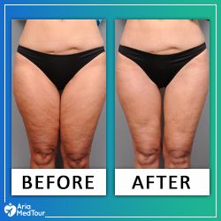 Featured-B-A-Thigh-Lift Thigh Lift Surgery Before And After, Thigh Lift Surgery, Inner Thigh Lifts, Thigh Lift, Before After Photo, Medical Tourism, After Surgery, Inner Thigh, After Photos