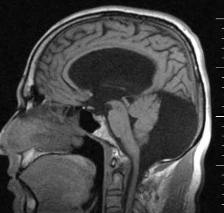 Posterior fossa arachnoid cyst with hydrocephalus Dysautonomia Pots, Lower Blood Pressure Naturally, Cerebrospinal Fluid, Brain Food, Improve Memory, Lower Blood Pressure, Radiology, Lose 20 Pounds, Medical Prescription