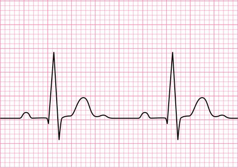 Sinus Rhythm Tattoo, Pink Girly Quotes, Normal Ecg, Ekg Technician, Ekg Tattoo, Sinus Rhythm, St Elevation, Normal Sinus Rhythm, Nurse Tattoo