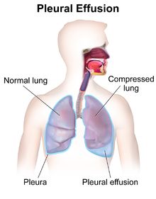 Pleural Effusion, Lymph Vessels, Kidney Pain, Basic Facts, Naturopathy, Things Under A Microscope, Shortness Of Breath, What Is The Difference Between, Respiratory System