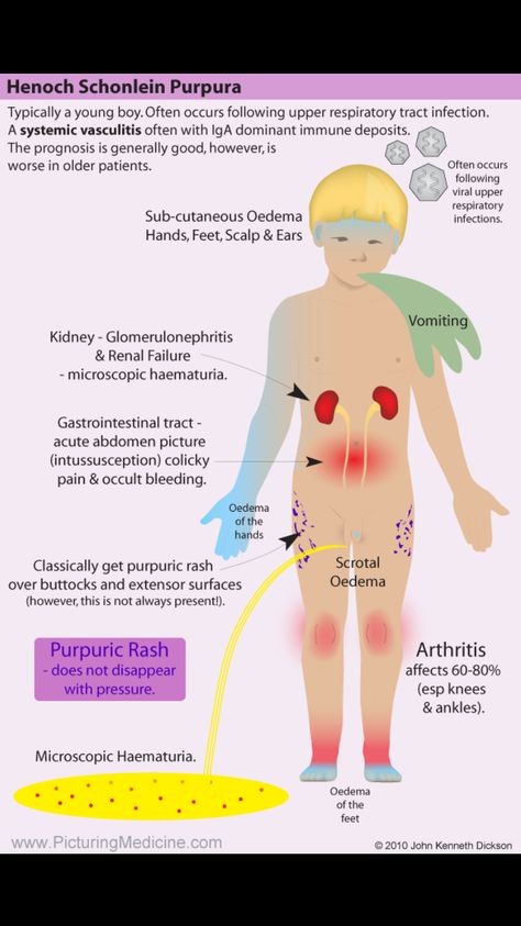 Henoch Schonlein Purpura. A classic pattern of disease as shown in the diagram below. This is available for free in the app "Picturing-MD" available on the App Store and Google Play. www.PicturingMedicine.com Henoch Schonlein Purpura, Neurofibromatosis Type 1, Physician Assistant School, Nursing Study Tips, Bells Palsy, Medical School Studying, Medical Anatomy, Nursing Study, Medical Knowledge