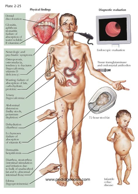 Celiac Disease Celiac disease, also known as gluten-sensitive enteropathy or nontropical sprue, is a chronic immune-mediated enteropathy triggered by Gi Anatomy, Med School Study, Integumentary System, Nursing Study Guide, Chronic Constipation, Nurse Study Notes, Nursing Student Tips, Nursing School Humor, Medical School Studying