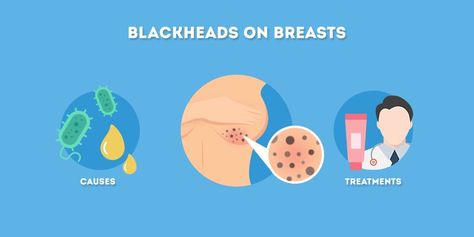 What Causes Blackheads, Exfoliation Routine, Chemical Exfoliation, Blackhead Mask, Mole Removal, Konjac Sponge, Remove Blackheads, Women Health Care, Sweat Gland