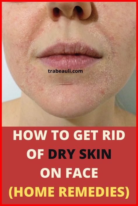 Natural Hacks For Your Skin Problems Dry Face Remedy, Flaky Skin On Face, Dry Skin Face Mask, Dry Peeling Skin, Get Rid Of Dry Skin, Good Moisturizer, Super Dry Skin, Facial For Dry Skin, Mask For Dry Skin