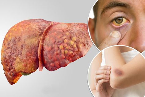 You may have serious liver damage if you experience these 5 warning signs, doctor says Popular Wedding Songs, Liver Damage, Liver Function, Weird But True, Remove Toxins, Liver Health, Beauty Foods, The Liver, Men’s Health