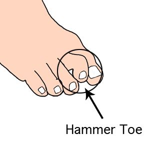 Hammertoe Remedies, Hammer Toe Correction, Toe Exercises, Toe Straightener, Toe Spacers, Knee Strength, Foot Exercises, Health Signs, Menstrual Health