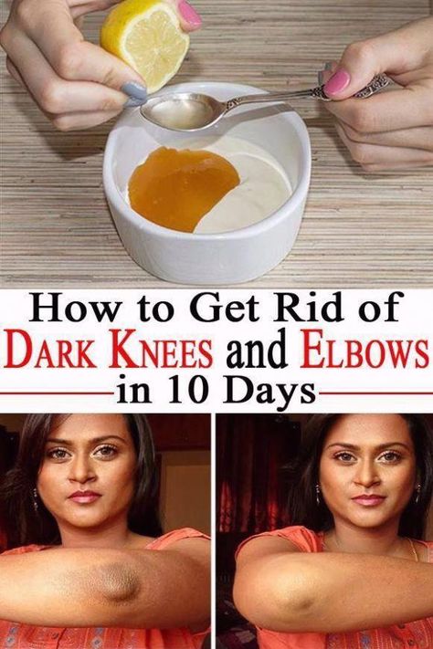 best organic skin care #remediesfordarklips #UnwantedBackHair Dark Knees And Elbows, Dark Knees, Dark Elbows, Skin Hacks, Natural Therapy, Beauty Remedies, Skin Remedies, Shaved Sides, Beauty Natural