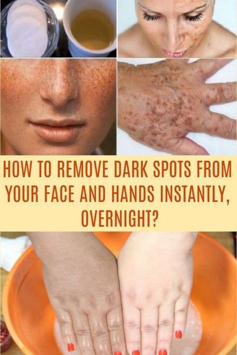 How To Get Rid of Pigmentation And Dark Spots Naturally - Food Blog How To Remove Moles, Sun Spots On Skin, Black Spots On Face, Remove Moles, Brown Age Spots, Brown Spots On Skin, Skin Moles, Mole Removal, Brown Spots Removal