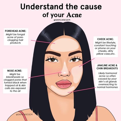 Closed Comedones, Skin Blackheads, Forehead Acne, Skin Facts, Skin Advice, Skin Aesthetics, Natural Face Skin Care, Types Of Acne, Acne Causes