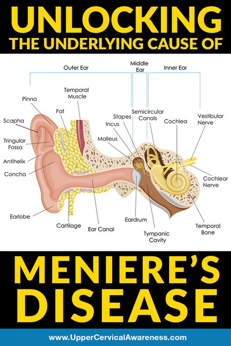 Minears Disease, Menieres Disease Symptoms, Ménière’s Disease, Vestibular Disorder, Meneires Disease, Ear Diseases, Vertigo Relief, Vertigo Remedies, Ear Problems