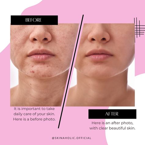 “Progress is power! 🌟 Consistency and care made all the difference in our client’s skin journey. This results are after two months of consistently using our Acne Skincare Line. (Results may vary, we don’t make any specific predictions or assurances) Achieving clear skin has been a journey for our clients, but every step has been worth it. The ‘before’ photo shows the struggles they faced with hormonal acne, while the ‘after’ reveals the results of dedication, consistency, and the right skinca... Before And After Acne, Skin Journey, Instagram Theme Feed, Acne Skincare, Hormonal Acne, What Happened To You, Trust The Process, August 17, Instagram Theme