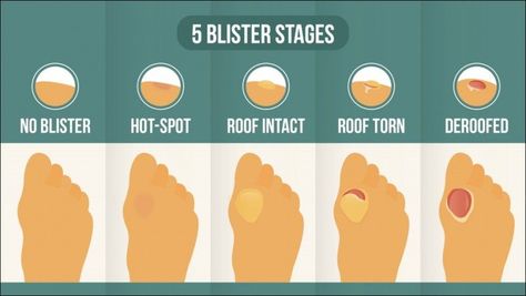 blister stages How To Treat Blisters, Blister Remedies, Wilderness First Aid, Mother Runner, Prevent Blisters, Random Aesthetic, The Camino, Aesthetic Quotes, My Nails