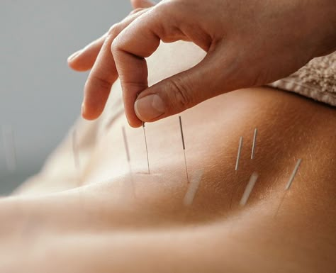 Acupuncture is a traditional Chinese method used to relieve some health conditions and symptoms, such as pain. Learn more about this technique. Hand Mudra, Sleeping Issues, Referred Pain, Acupuncture Clinic, Root Chakra Stones, Tattoos Infinity, Tattoos Mandala, Trigger Point Therapy, Inspiration Tattoo